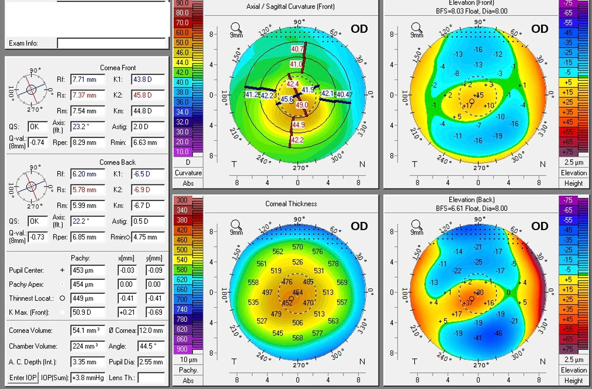 Corneal topography displaying axial curvature, elevation, and thickness maps for the right eye (OD) of an advanced keratoconus patient.