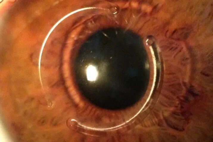 Close-up of a human eye with two clear corneal allogenic intrastromal ring segments (CAIRS) implanted for keratoconus treatment.