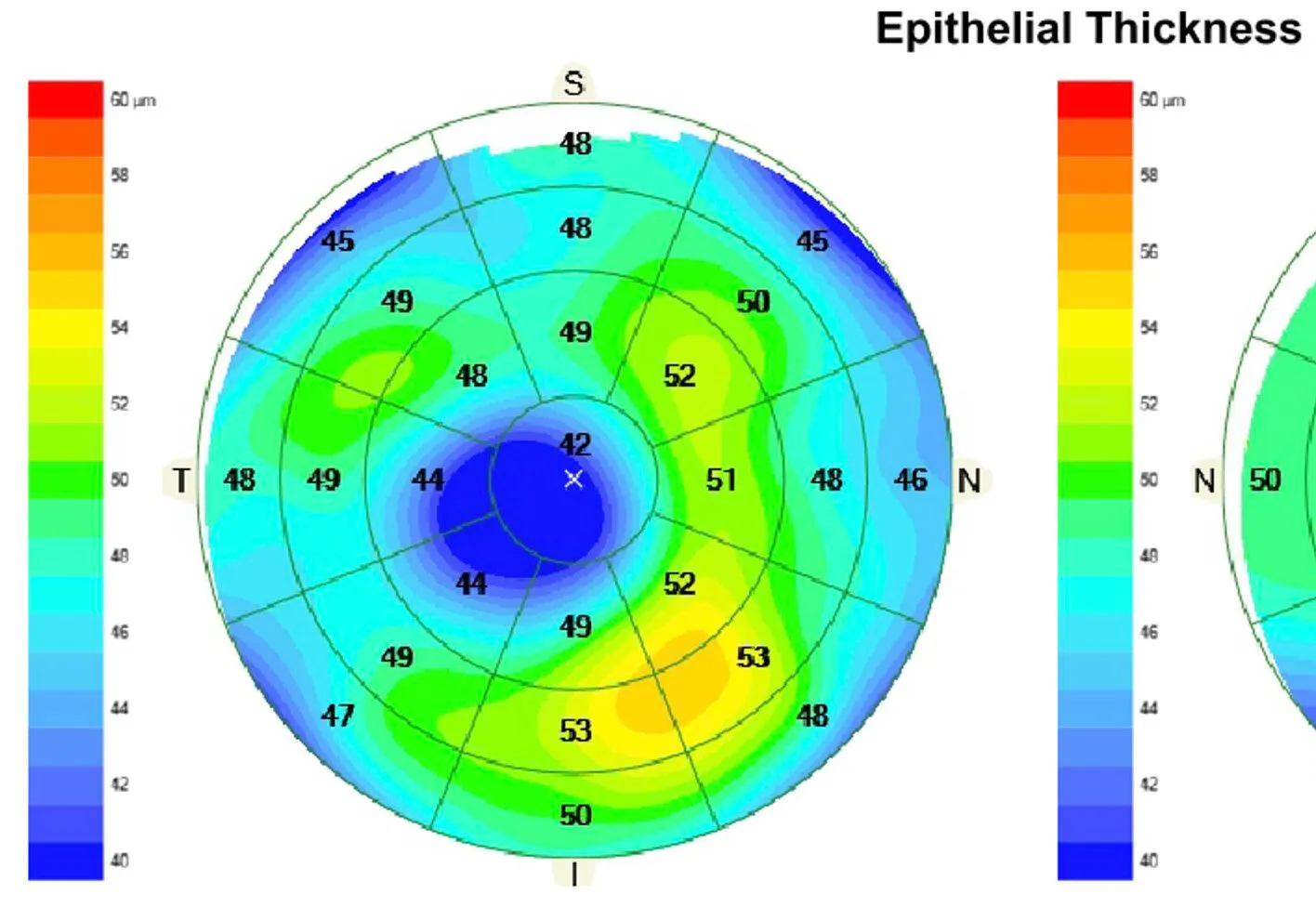 Color-coded corneal epithelial thickness map with numerical values, crucial for diagnosing and monitoring keratoconus.