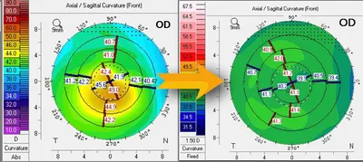 Corneal topography maps showing keratoconus before (left, steep irregular cornea) and after (right, smoother cornea) Phorcides treatment.