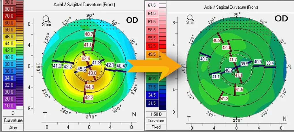 Corneal topography maps showing keratoconus before (left, steep irregular cornea) and after (right, smoother cornea) Phorcides treatment.