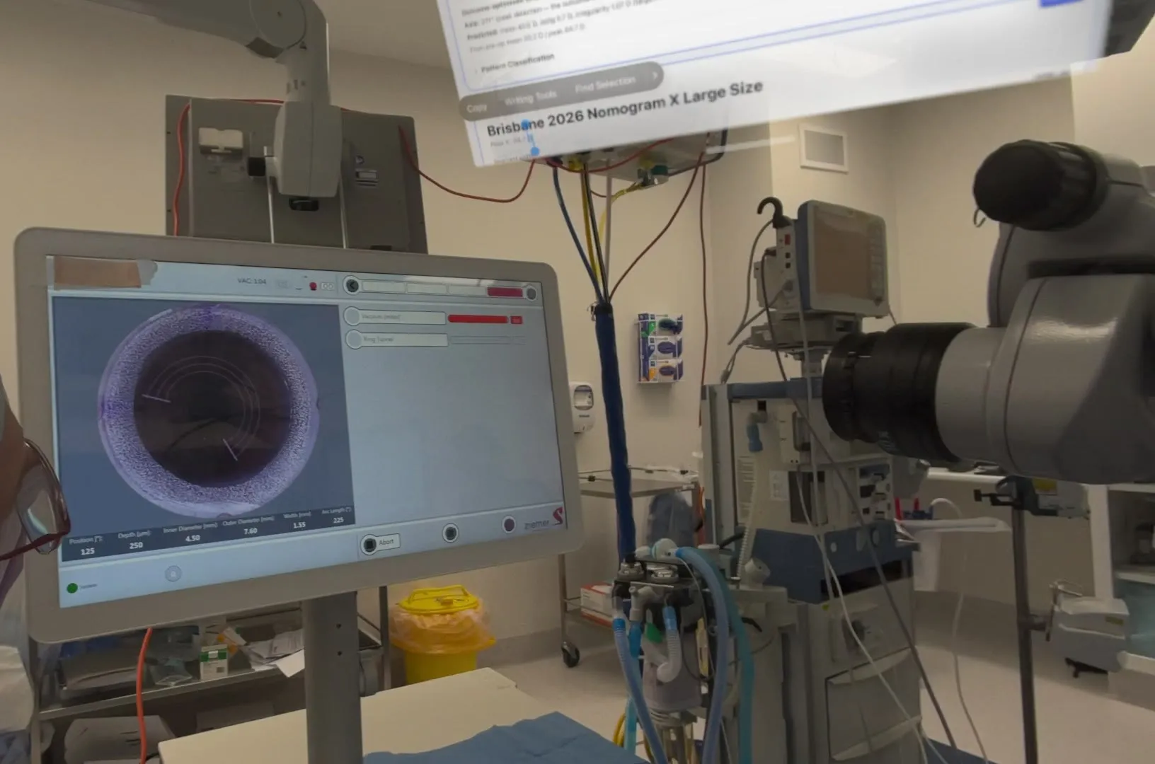 The Ziemer Z8 laser cutting CAIRS channels while a CAIRSPlan window titled Brisbane 2026 Nomogram floats in the surgeon's view above the theatre.