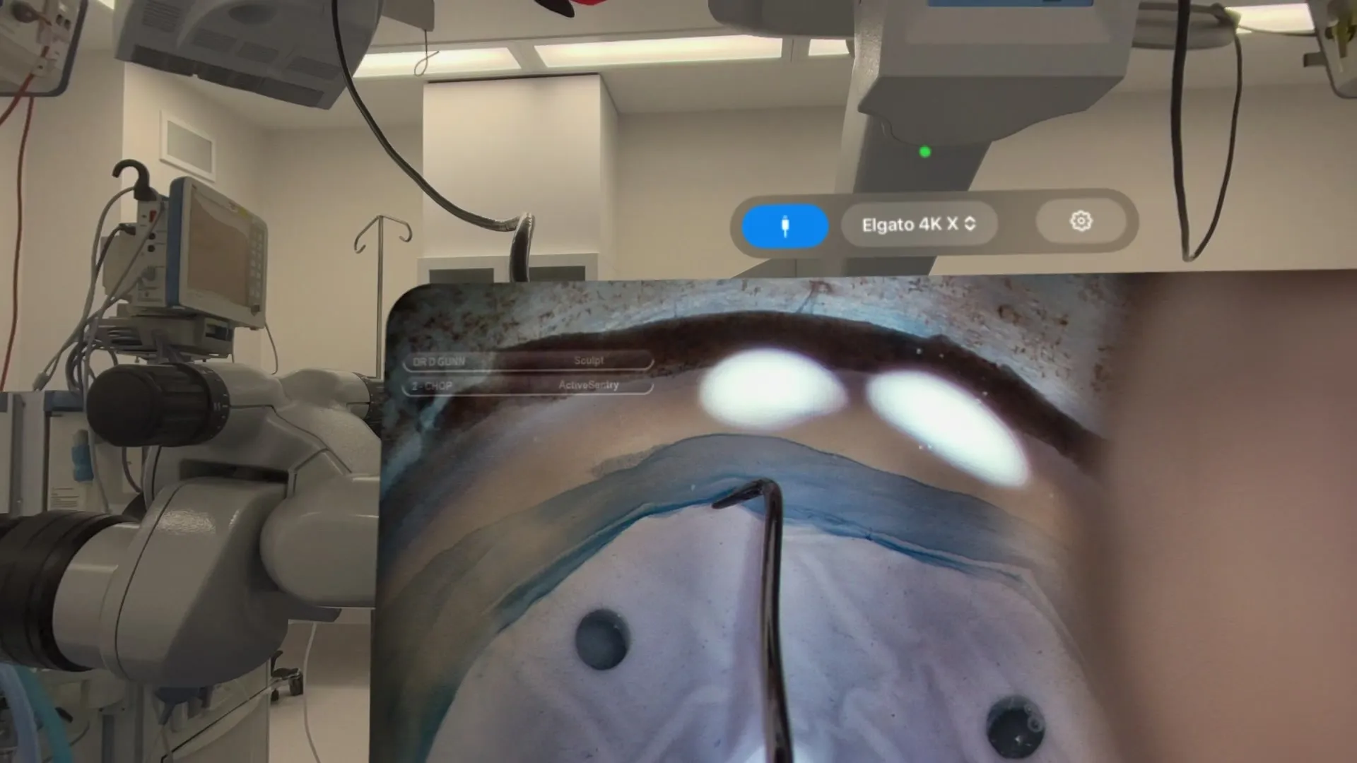 The live surgical view floating as a large window in the operating theatre, seen from inside the Apple Vision Pro during cataract surgery.