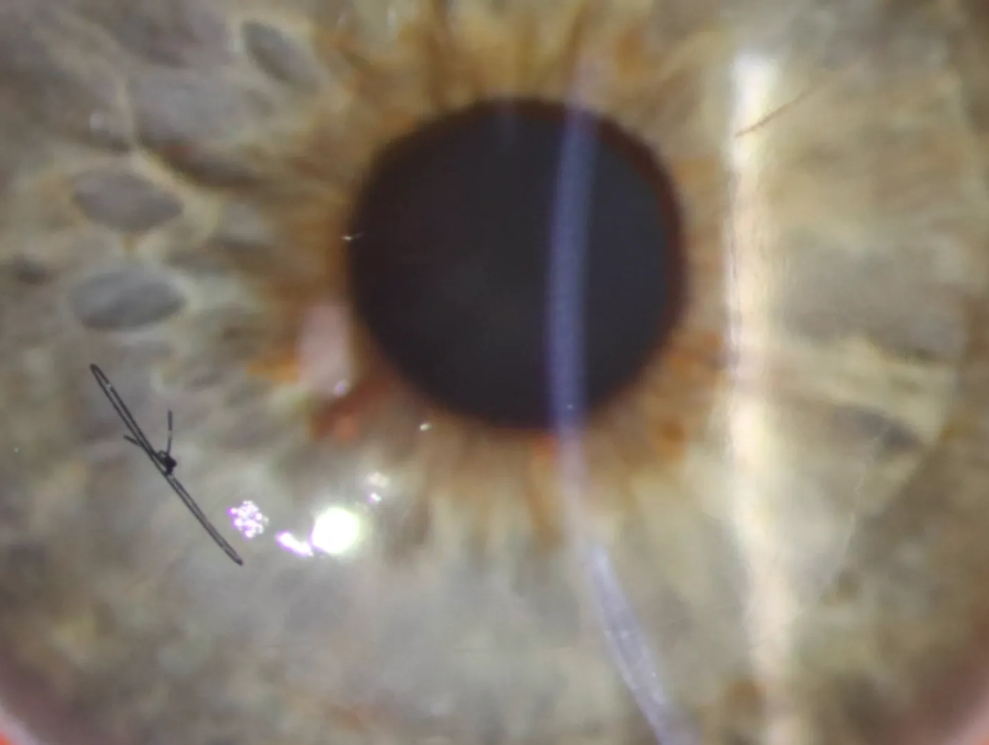 Close-up of an eye after CAIRS (Corneal Allogenic Intrastromal Ring Segments) treatment for keratoconus, showing a visible corneal structure.