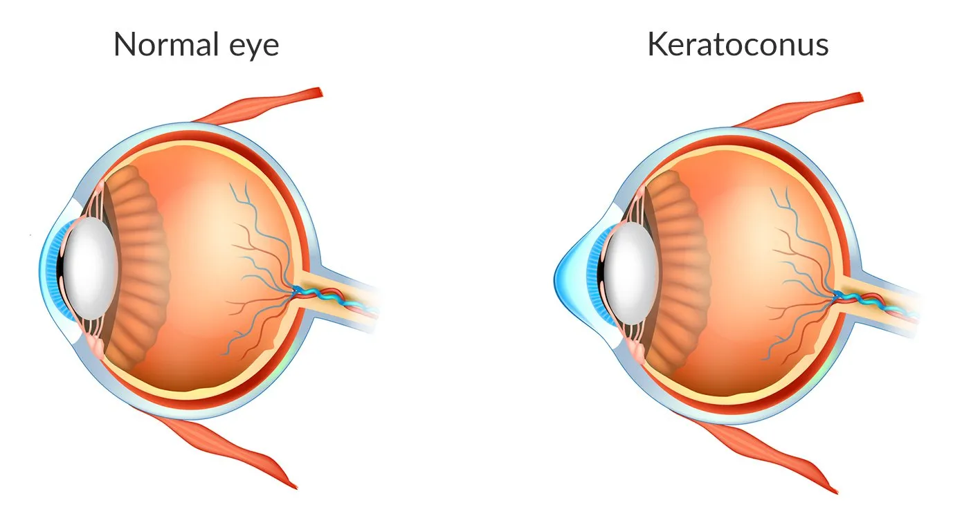 Medical diagram comparing a normal eye with a healthy, rounded cornea to an eye with keratoconus, featuring a cone-shaped cornea.