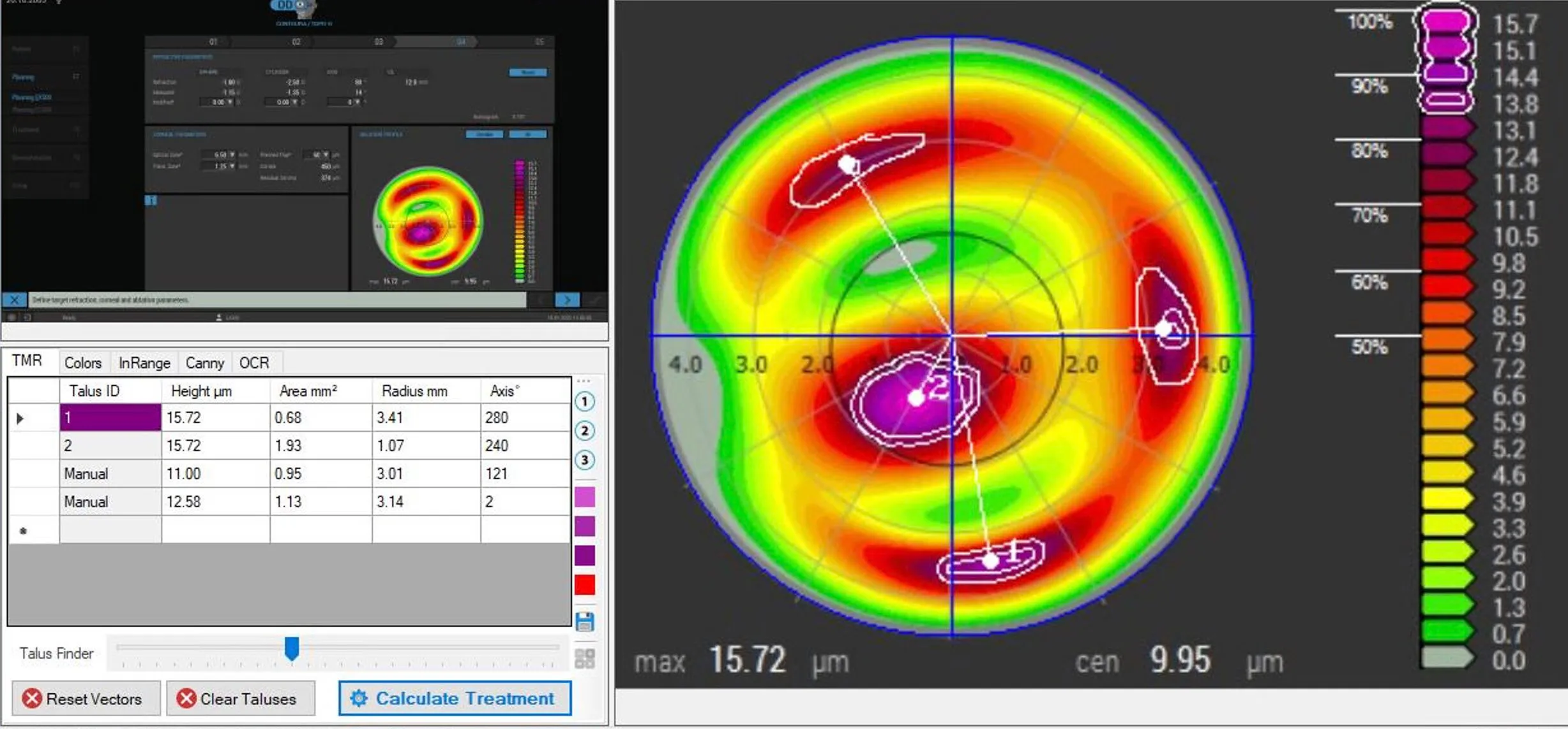 Phorcides corneal topography map showing color-coded elevation, with a table of measurements for advanced keratoconus treatment planning.