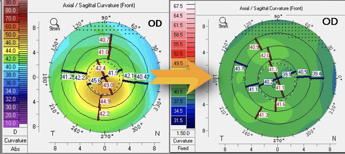 Corneal topography maps showing keratoconus before (left, steep irregular cornea) and after (right, smoother cornea) Phorcides treatment.