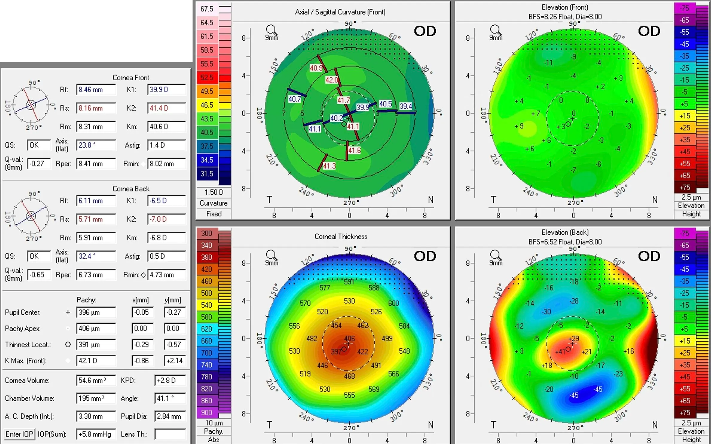 Pentacam corneal topography and pachymetry report (OD) showing diagnostic maps for keratoconus, including curvature, elevation, and thickness.