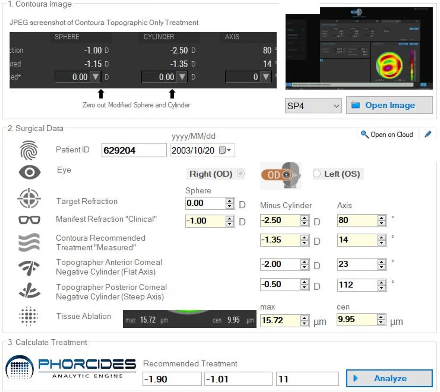 Phorcides Analytic Engine interface showing patient eye measurements, Contoura topography, and recommended treatment for keratoconus.