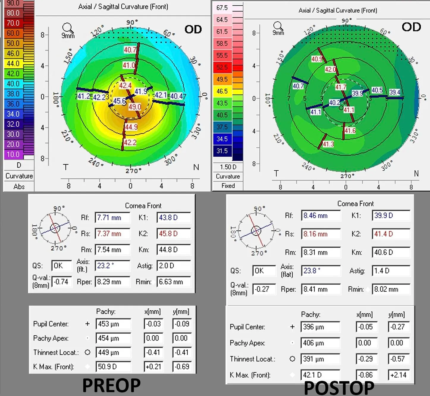 Corneal topography comparing severe keratoconus (left) with improved, flatter cornea (right) after advanced Phorcides treatment.