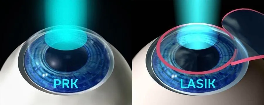 Animation comparing PRK and LASIK laser eye surgery, showing laser reshaping cornea directly for PRK and under a flap for LASIK.