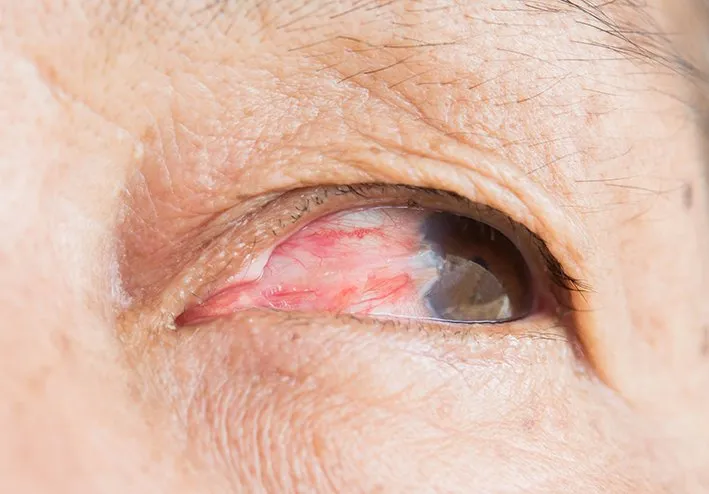 Close-up of an eye showing a visible pterygium, a red, fleshy growth extending from the conjunctiva toward the iris.
