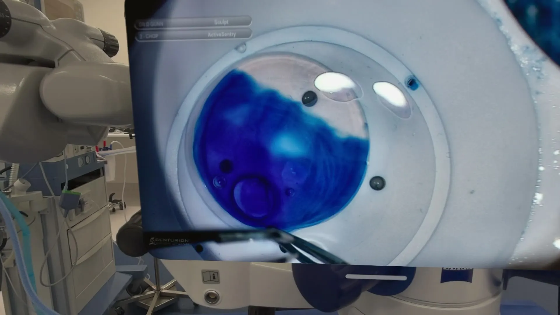Trypan blue staining of the lens capsule seen through the Apple Vision Pro during cataract surgery, with Dr Gunn's phaco settings visible on the Centurion overlay.