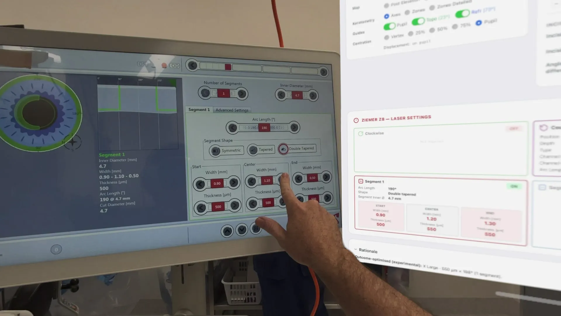 Dr David Gunn programming the Ziemer Z8 femtosecond laser touchscreen, with the CAIRSPlan laser settings panel floating in the Apple Vision Pro view beside the machine.